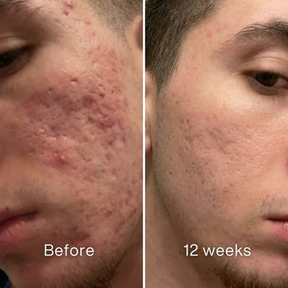 Clinical Acne Scar Remodeling Stick™